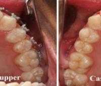 Conservative Management of Impacted Teeth: Report of 9 Cases