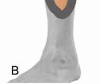  Interest of Fasciocutaneous and Muscular Flaps in the Management of Open Fractures of the Leg in Adults in the Orthopedics-Traumatology Department of the Ignace Deen University Hospital in Conakry