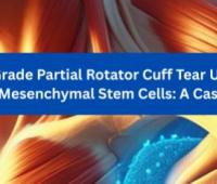  Healing of a High-Grade Partial Rotator Cuff Tear Using Bone Marrow-Derived Mesenchymal Stem Cells: A Case Report