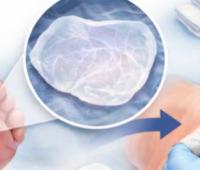 Early Feasibility and Safety of a Placental Amnion Membrane as an Adjunct to Standard Care for Diabetic Foot Ulcers