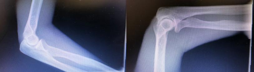 Treatment of Elbow Arthritis with a Bone Marrow derived 