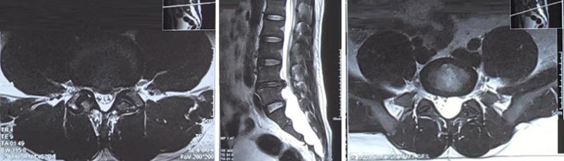 Guillain-Barre Syndrome Mistaken for a Lumbar Spinal Disorder: A 